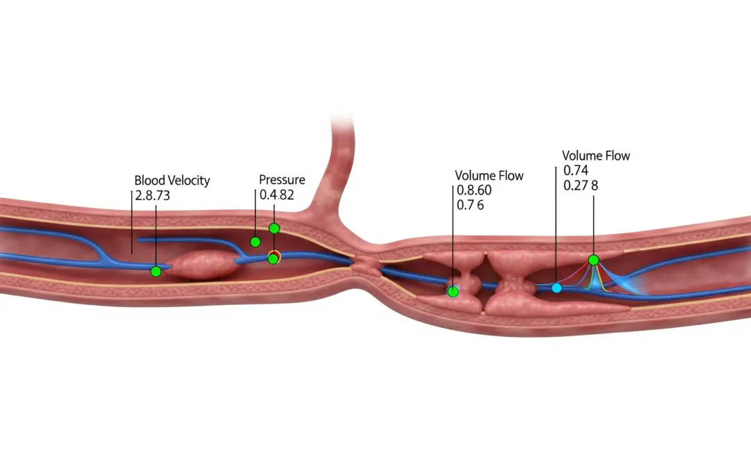 Dynamique des fluides dans une artère rétrécie